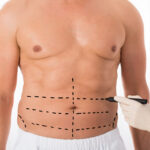 The Benefits of Vaser® High Definition Liposculpture for Men